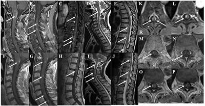 Reversible Conduction Failure in Anti-lactosylceramide-antibody-positive Combined Central and Peripheral Demyelination